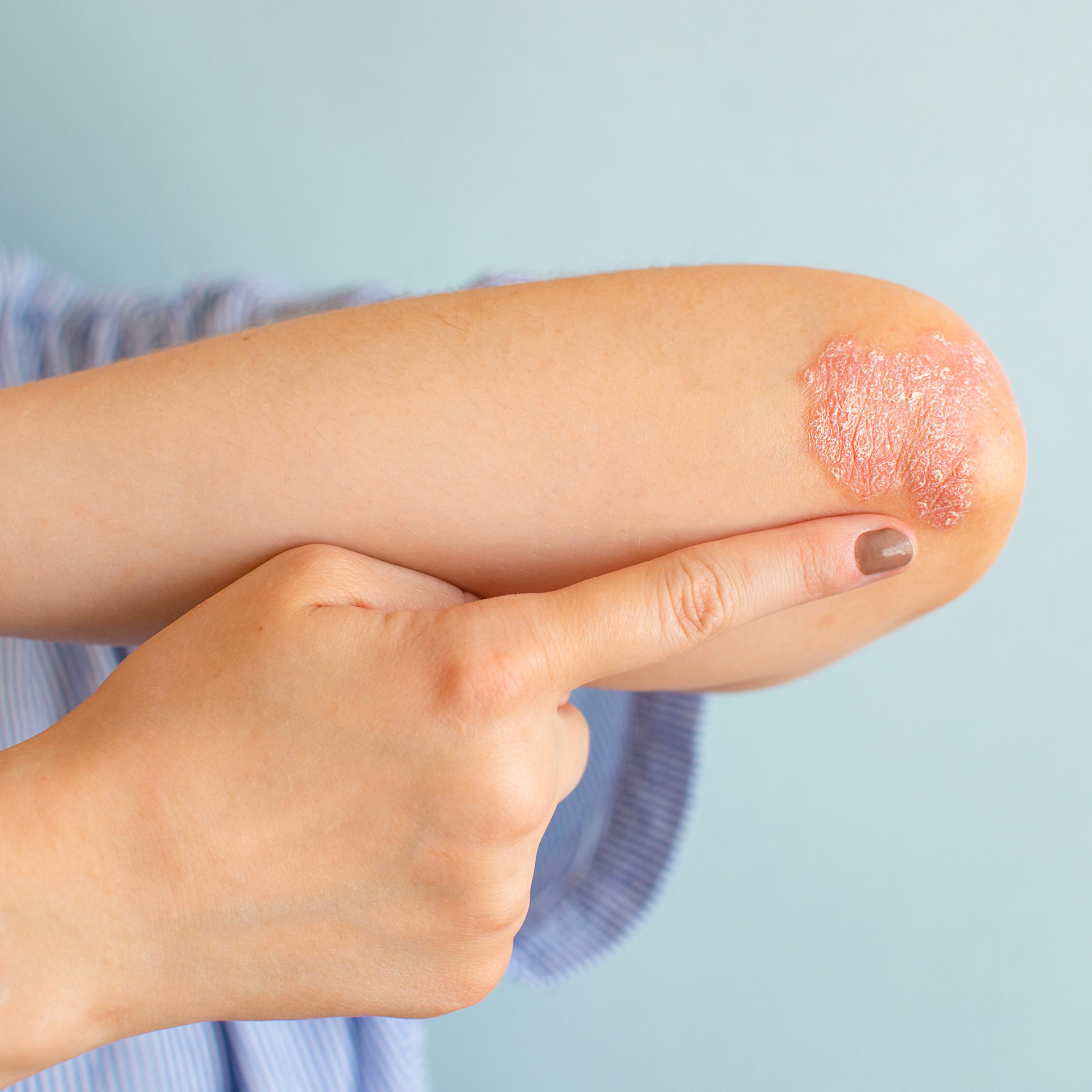 what is psoriasis